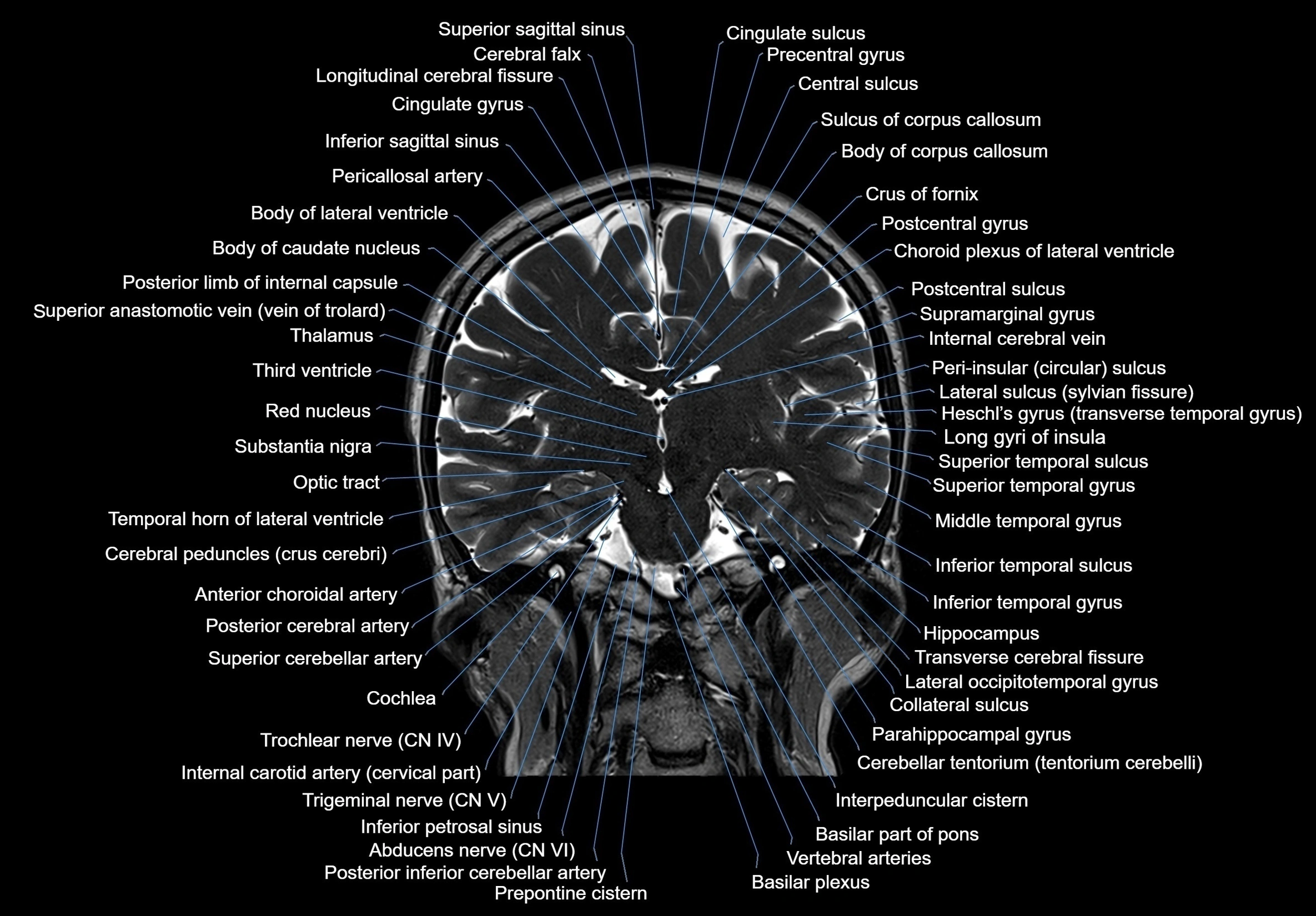 MRI Brain coronal cross sectional labelled anatomy 3T image  -img-00001-00041.webp